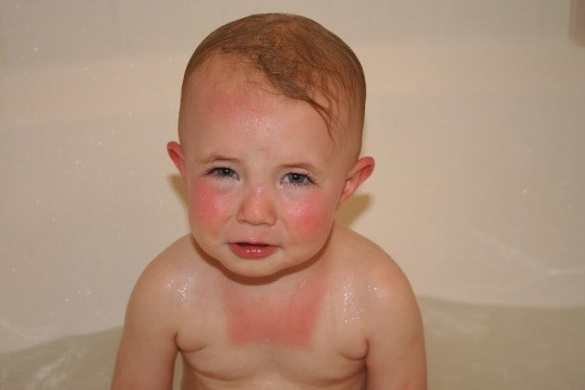 The Vital Importance of Protecting Your Redhead Kids from ...