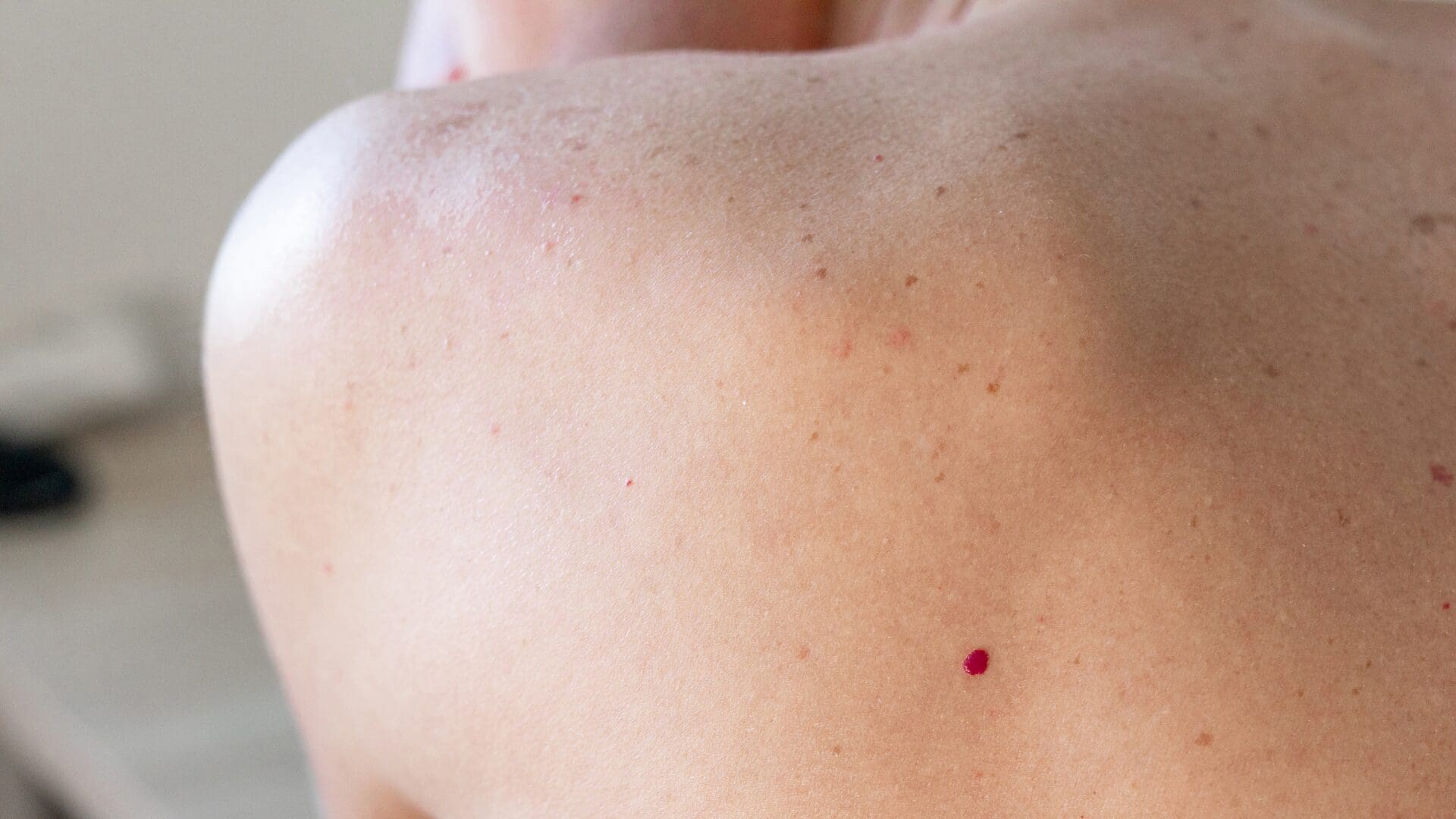 The Causes Of Cherry Angiomas & What To Do About These ‘Red Freckles’