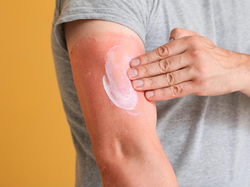 Do These Common Sunburn Remedies Actually Work?