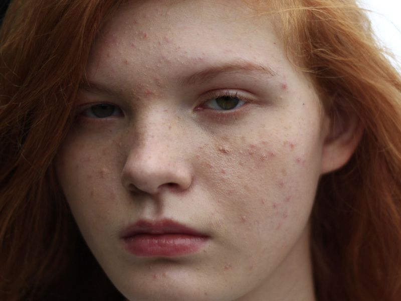 Why Is My Redhead Skin Breaking Out? 4 Ways To Cure Acne