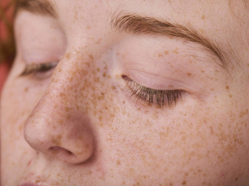 How To Learn To Love Your Freckles