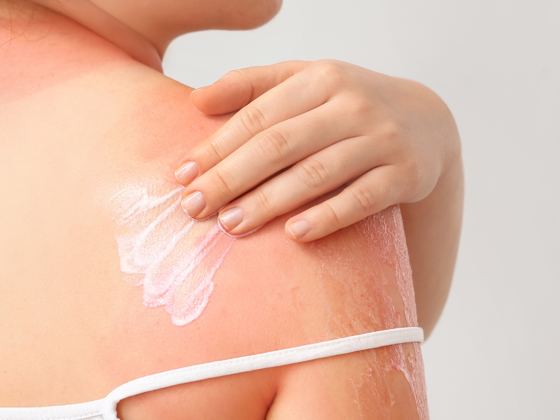 How Redheads Can Treat a Sunburn at Home—and When to Visit the Burn Center