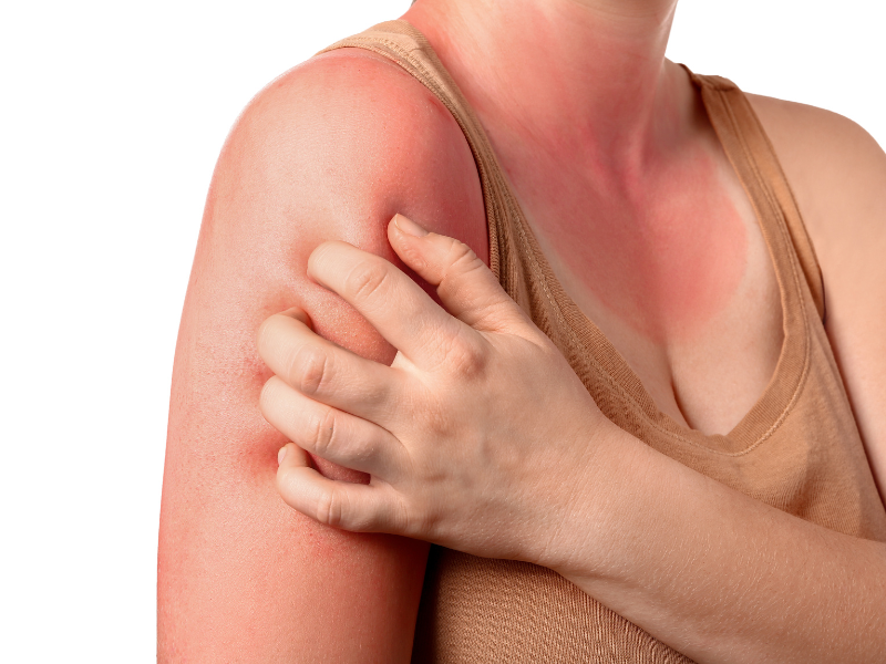 9 Signs of Sun Poisoning Redheads Should Watch For
