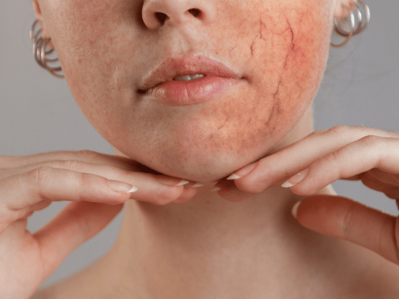 Skincare Mistakes & Ingredients For Redheads With Rosacea To Avoid